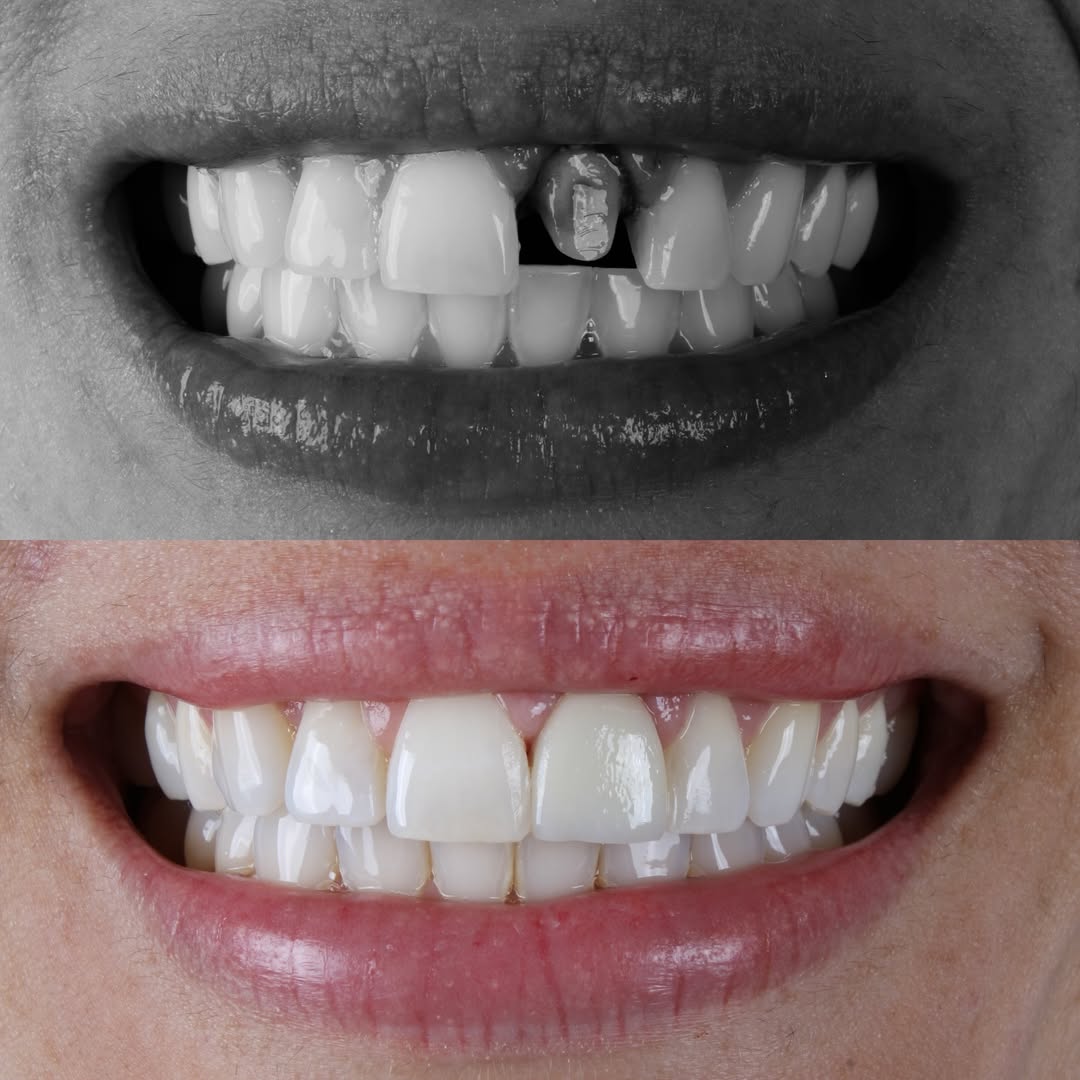 Antes e depois — caso 5